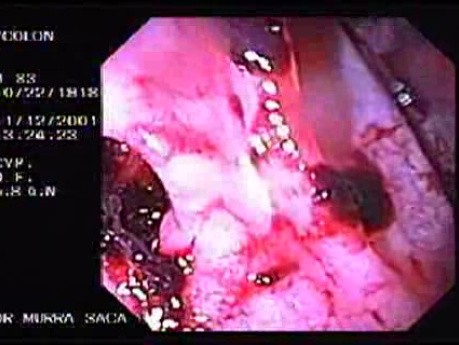 Diverticular Disease - Hemorrhage (2 of 15)