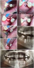 Implant Mandibular Surgery