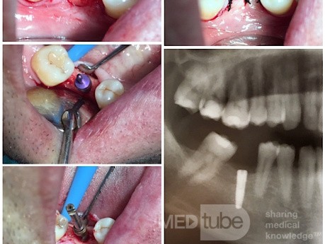 Implant Mandibular Surgery