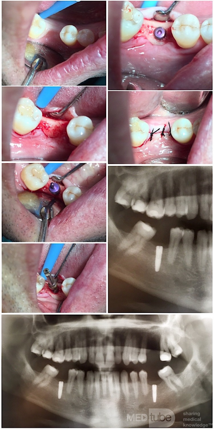 Mandibular Implant Surgery