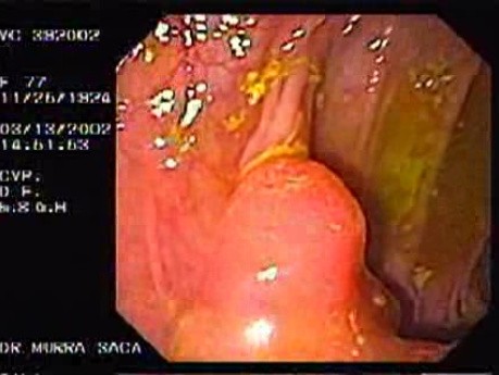 Adenocarcinoma Of The Transverse Colon - Endoscopy (1 of 9)