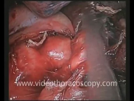 Left upper trisegmentectomy (lingular sparing) by uniportal thoracoscopic approach.