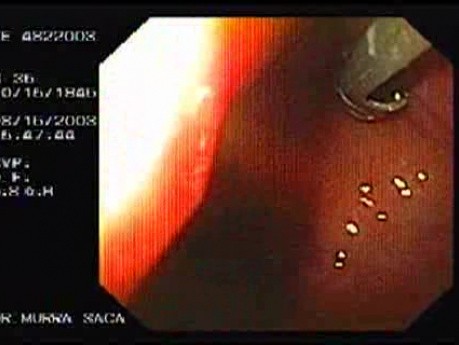 Flexible Endoscopic Suturing Device, Part 1
