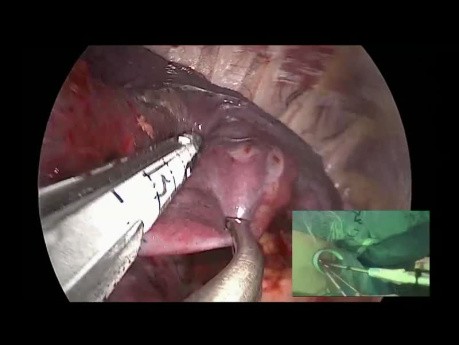 Live Surgery From Jerusalem: Uniportal VATS Right S1 Segmentectomy