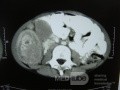 Intussusception, non Hodgkin's lymphoma CT