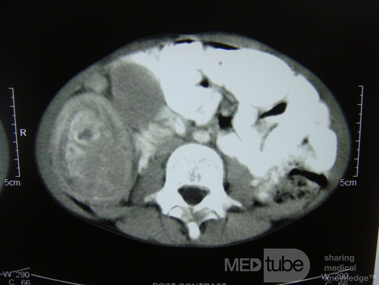 Intussusception, non Hodgkin's lymphoma CT