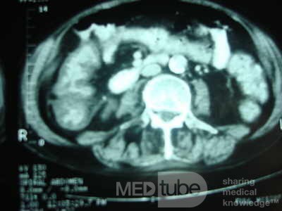 Pseudomembranous Colitis (10 of 11)
