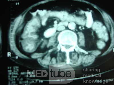 Pseudomembranous Colitis (10 of 11)