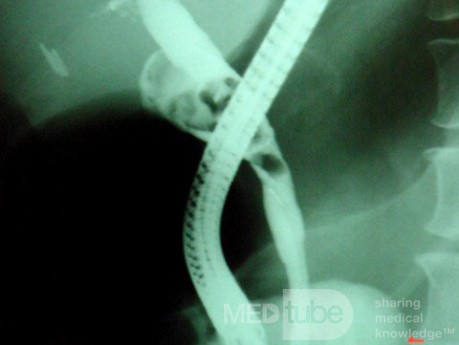 Post Cholecystectomy Mirizzi’s syndrome