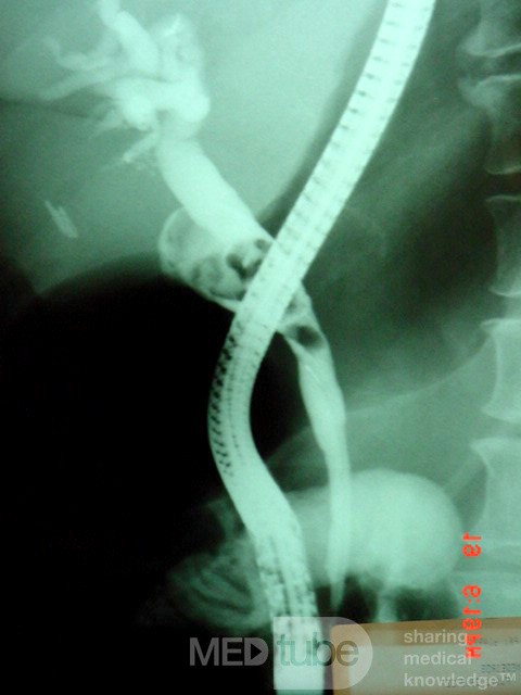 Post Cholecystectomy Mirizzi’s syndrome