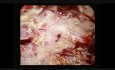 Laparoscopic Excision of Hydatid Cyst of Liver