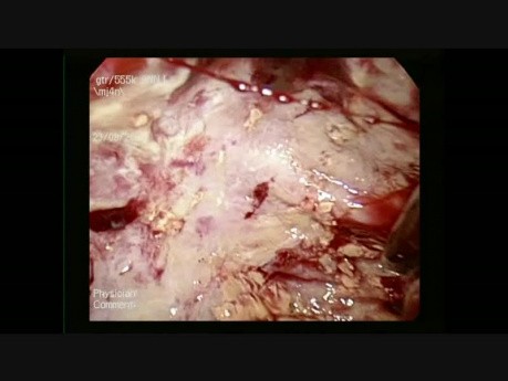 Laparoscopic Excision of Hydatid Cyst of Liver