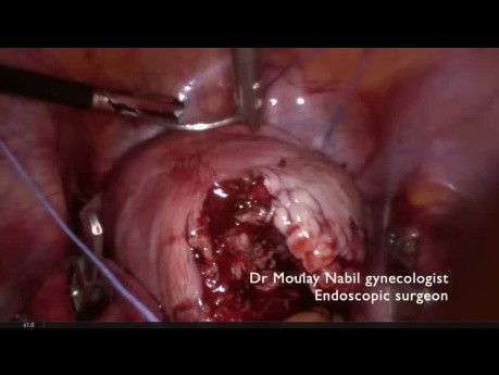 Tips and Tricks for Laparoscopic Myomectomy