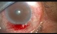 Accidental Entry of Blood in Conjunctival Lymphatics, During Surgery