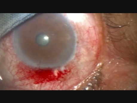 Accidental Entry of Blood in Conjunctival Lymphatics, During Surgery
