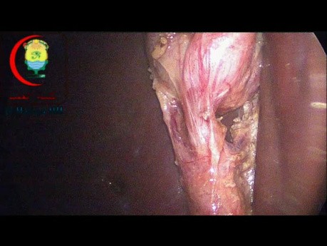 Long Cystic Duct Dissection