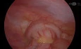 Laproscopic Appendectomy - Appendicitis in 13 Years Old Girl