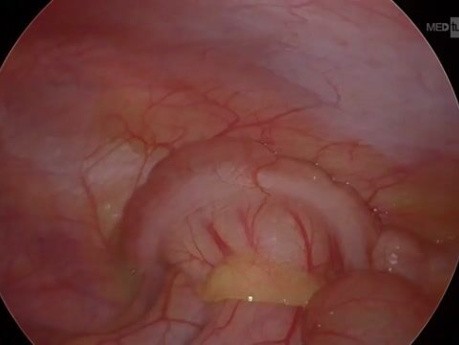 Laproscopic Appendectomy - Appendicitis in 13 Years Old Girl