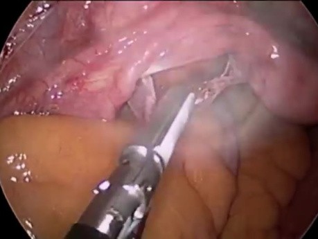 Myomectomy Single Site