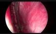 Endoscopic Removing of Polyps from the Sinuses