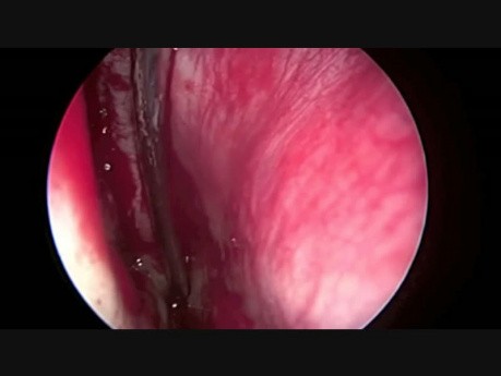 Endoscopic Removing of Polyps from the Sinuses