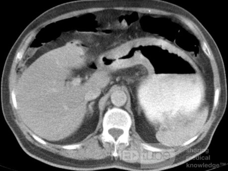 ScirrhousGastric Carcinoma (Linitis Plastica) (8 of 9)