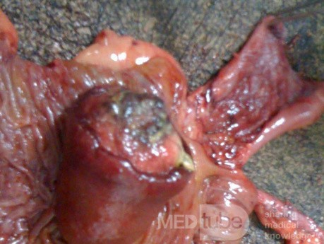 Ascending Colon Intussusception due to a Adenocarcinoma (3 of 6)