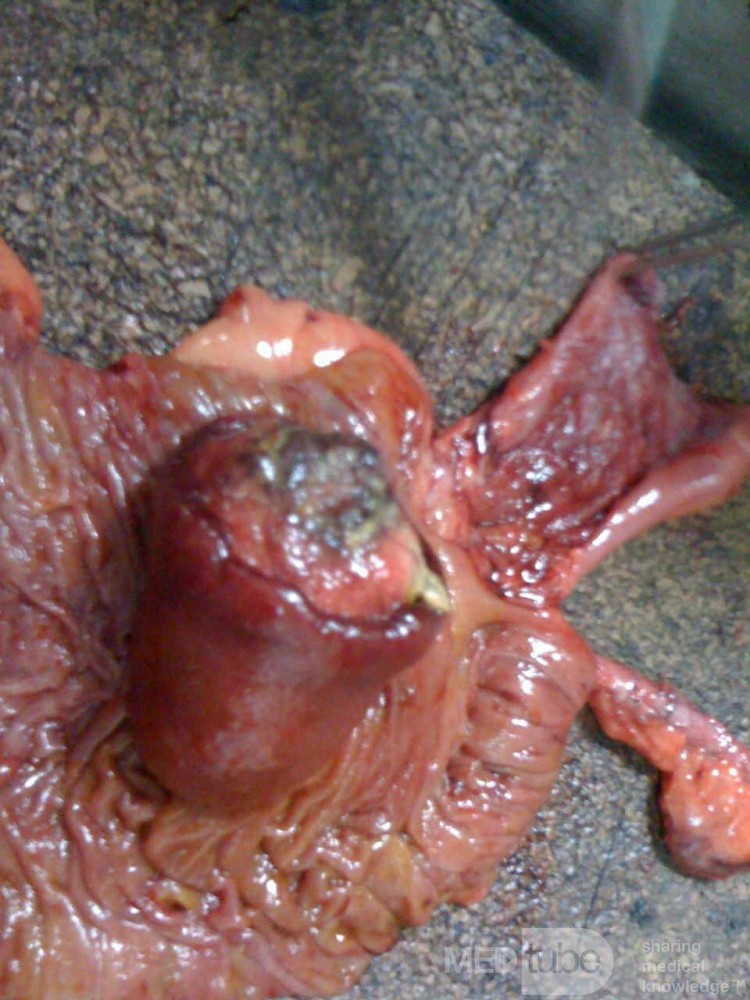 Ascending Colon Intussusception due to a Adenocarcinoma (3 of 6)