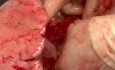 Usage of Pericardial Patch for LA Back Table Reconstruction 