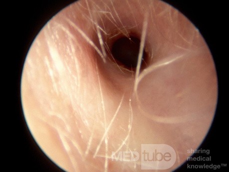 Aquired Stenosisof the External Auditory Canal