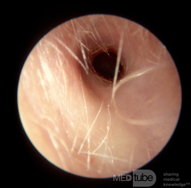 Aquired Stenosisof the External Auditory Canal
