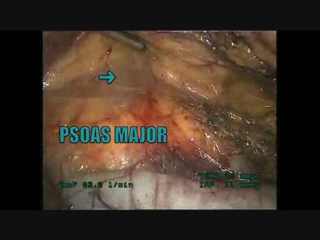 Right Radical Nephrectomy