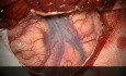 Amygdalohippocampectomy