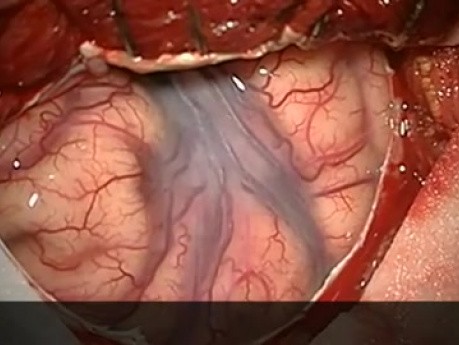 Amygdalohippocampectomy