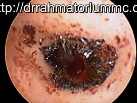 Ear Canal Laceration by Alleged Q-Tip Usage After The Trauma