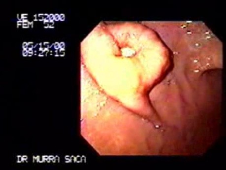 Submucosal Adenocarcinoma