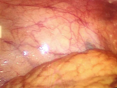Peritoneal Tuberculosis in laparoscopy
