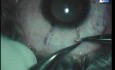 Conjunctival autograft with fibrin glue
