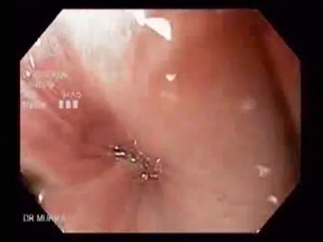 Narrow Band Imaging (NBI)