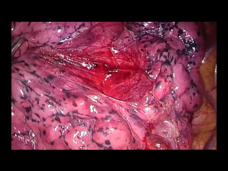 Uniportal VATS Anatomic Right Basal Bisegmentectomy S9-10