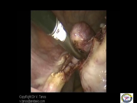 Diagnostic Laparoscopy To R/O Malignancy Due To Suspicious Cytology