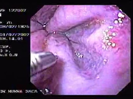 Hemorrhage Due Status Post Rubber Band Ligation of Esophageal Varices - Follow Up 12 Days After Sclerotherapy