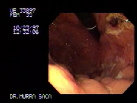 Linitis Plastica - Endoscopy