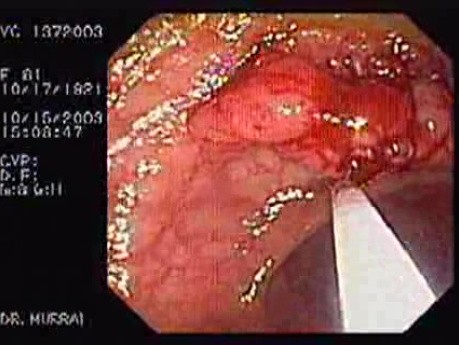 Tubulo - Villous Adenoma - Endoscopy (21 of 28)