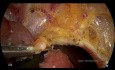 TAMİS - TransAnal Minimally Invasive Surgery for T1 Malign Rectal Polyps