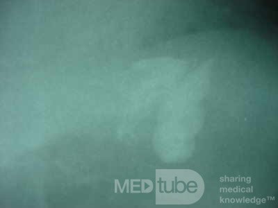 Large Gastric Varices (25 of 25)