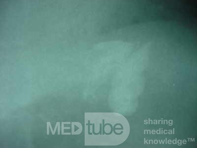 Large Gastric Varices (25 of 25)