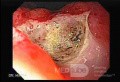 Two Ulcers in a Cirrhotic Patient - Assessment of the Ulcer
