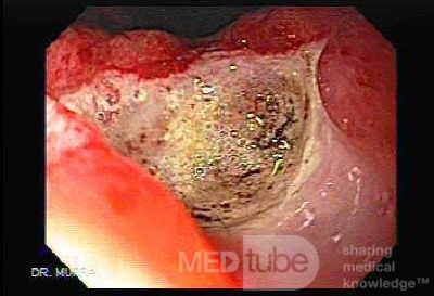 Two Ulcers in a Cirrhotic Patient - Assessment of the Ulcer