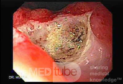 Two Ulcers in a Cirrhotic Patient - Assessment of the Ulcer